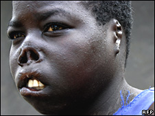 A teenage girl abducted by LRA rebels, who cut off her lips, nose and ears before she was able to escape 
